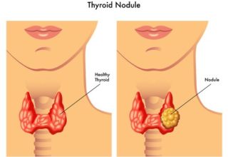 Thyroid Nodules & Thyroid Cancers